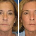 “Mi dermatóloga siempre habló sobre la protección solar, pero fue cuando adopté la rutina del Dr. Ivo Pitanguy e incluí el uso diario de protector solar que vi mi piel rejuvenecer. Las manchas solares desaparecieron, las líneas finas se suavizaron, ¡y me siento al menos 5 años más joven!" — Carla, 50 años